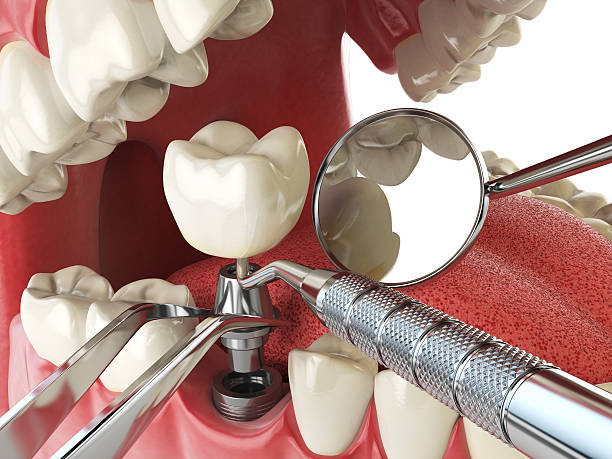 Best Emergency Denture Repair in Minooka, IL